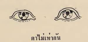 ตาไม่เท่ากัน